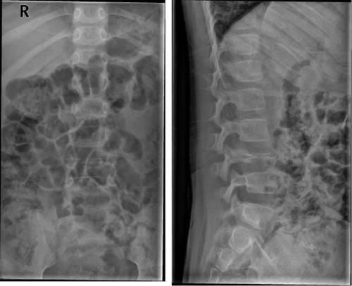 椎体|脊柱常见肿瘤及肿瘤样病变的几种影像学表现，你都见过吗？