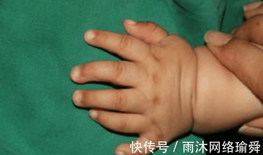 医生|孩子出生就有25根指头, 医生看到宝妈的手, 明白了原因