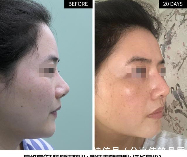 硅胶 硅胶隆鼻——挛缩、朝天是致命伤,要怎么修复看她20天术后变化!
