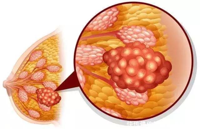 结节|体检报告上的“结节、增生、囊肿、息肉”，到底用不用治？