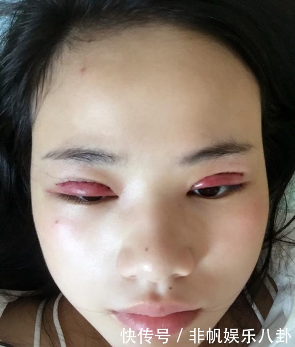 维权|劝你别割“双眼皮”,整容师透露3点,割过的人很后悔