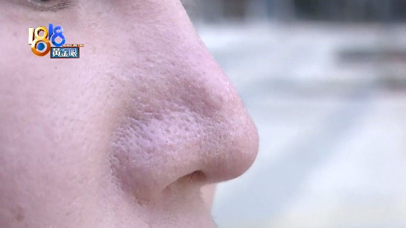 假体|鼻子术后有凹凸，“童颜”说“挛缩现象”