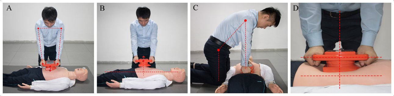 心肺复苏|腹部提压心肺复苏术，该出手时就出手