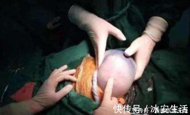 分娩|90后孕妇生下“带壳宝宝”,丈夫情绪失控,医生却说是个幸运儿
