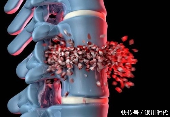 骨質(zhì)疏松“偏愛(ài)”6類人,需特別關(guān)注骨骼健康,看看你是否在其中