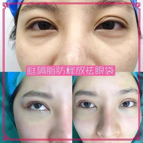 显美眼袋手术恢复期要多久,做眼袋手术后吃什么好处多?