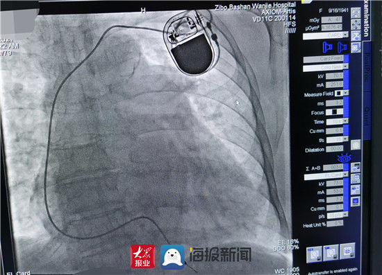 心率|万杰医院：80岁老人成功植入心脏起搏器 心跳从此不再“慢一拍”