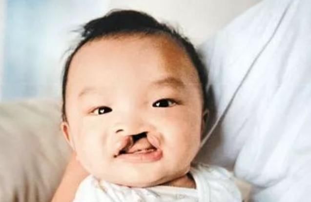 妈妈|怀孕6个月查出兔唇,全家人伤心不已,医生诊断:宝爸要背锅了