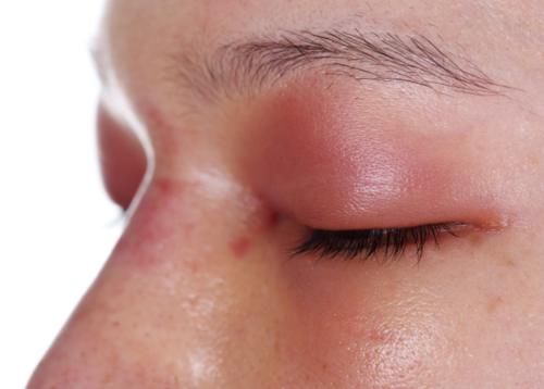 水肿|肾功能出现下降也是有“信号”的，快看看你有没有！