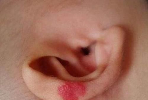 胎儿|孕妈吃酱油会让胎儿脸上长胎记？孕期做好这几项防护，让胎记远离