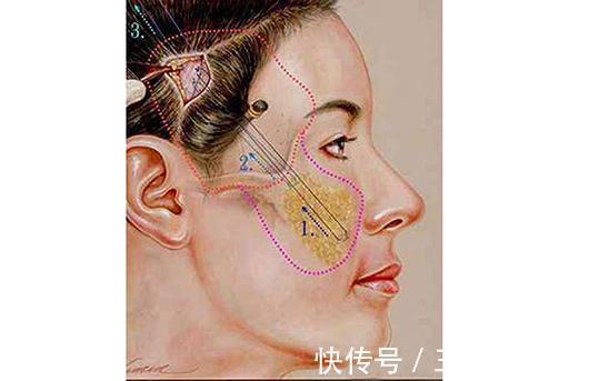 拉皮 拉皮除皱王小民教授:小拉皮改善下垂,青春回来了!