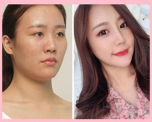 显美眼袋手术恢复期要多久,做眼袋手术后吃什么好处多?