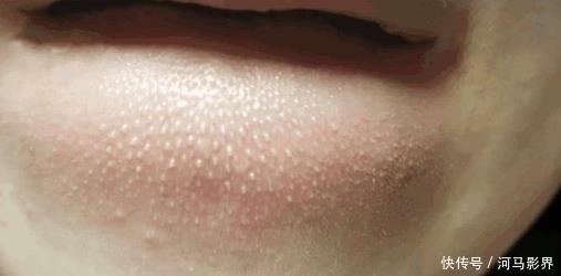小疙瘩|抿紧下巴后突起的“白疙瘩”,千万要注意,这是螨虫的真身吗