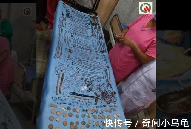 比斯瓦斯|印度一女子身体里竟取出价值45万的珠宝:69条链子,80个耳环