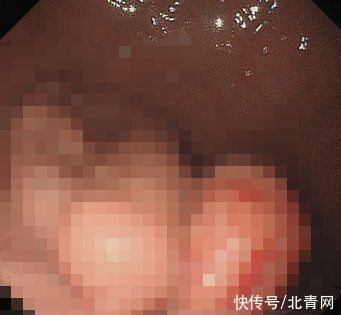 男孩|辣条泡面当饭吃了两年多，12岁男孩胃里长出鸡蛋大肿瘤！医生提醒……