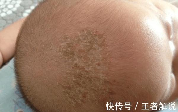 植物油|新生儿头上脏脏，忍不住用手去抠？当心把宝宝抠进医院