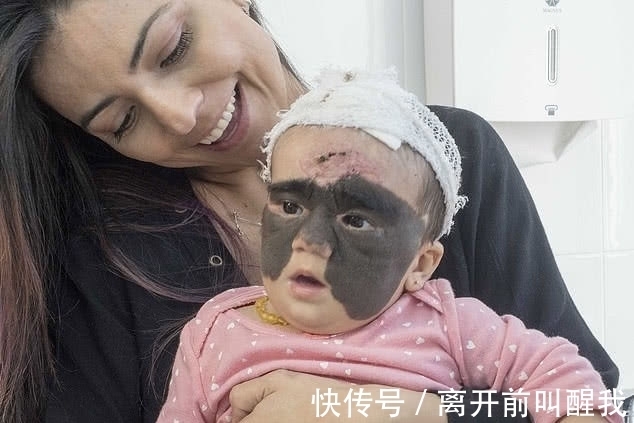 面具|7个月婴儿脸上因巨大黑色胎记爆红!像带着“蝙蝠侠”面具!