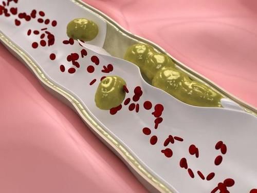 胆固醇|早上起床喝一杯温水，能降血脂吗？文章中或告诉你答案