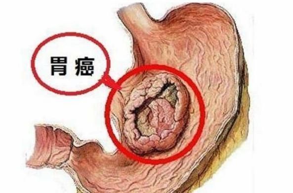 食物|养胃冠军已公布,不是小米粥,经常吃,灭幽门螺杆菌,胃或更舒坦