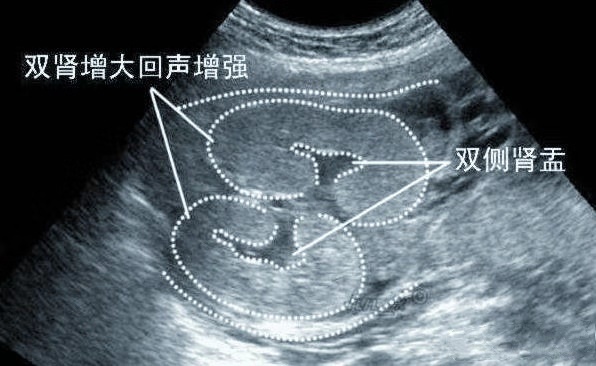 孕妇|胎儿双肾盂分离，孕妇很高兴，“这下儿女双全了”，医生苦笑摇头