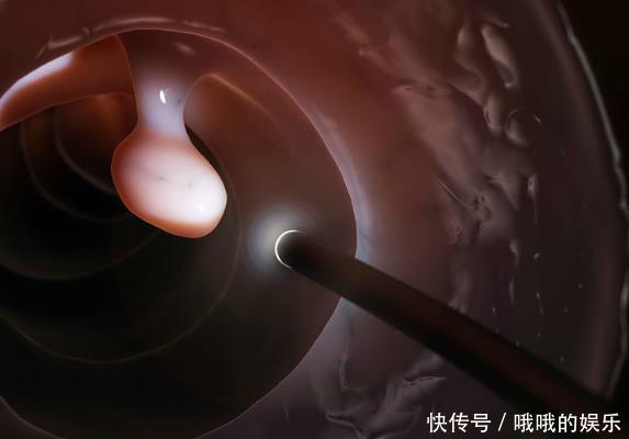 检查|上厕所时若出现3个迹象,或许是肠道有息肉了,请尽早去检查下