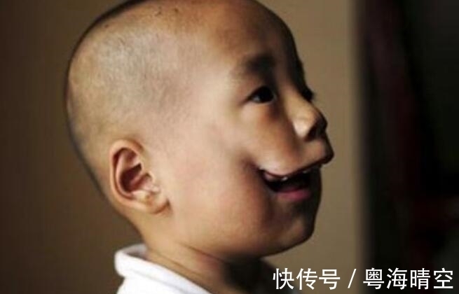 男婴|男婴出生时脸部畸形,多次孕检未检验出,专家给出这样的解释