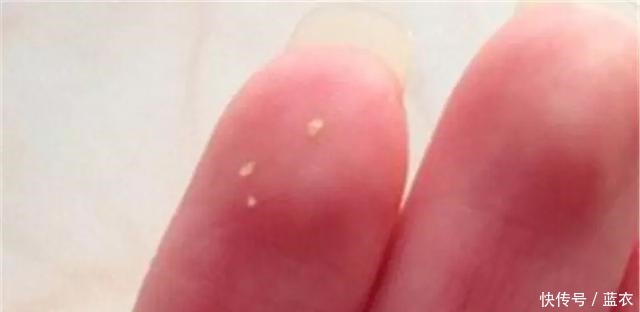 皮肤|鼻上黑头别傻傻再用手挤,皮肤科医生教你一招,让黑头自动流出来!