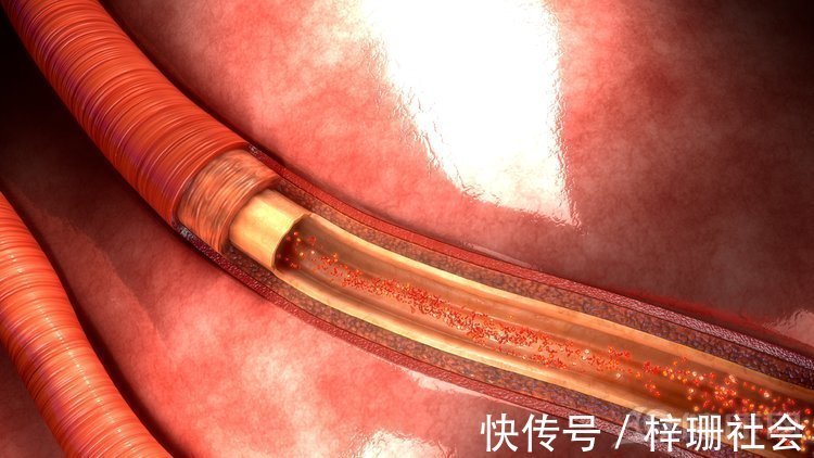 慢性疾病|跟你的命有关！这4个高血脂说法是谣言，你该醒醒了