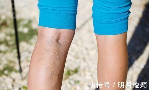 缺血|晚上泡脚，是养生还是“慢性自杀”？医生：5种人泡脚百害无一利