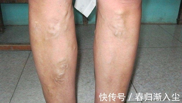 血液瘀滞|血管堵没堵,看青筋就知道,此物常吃,血管通了,还能降血脂