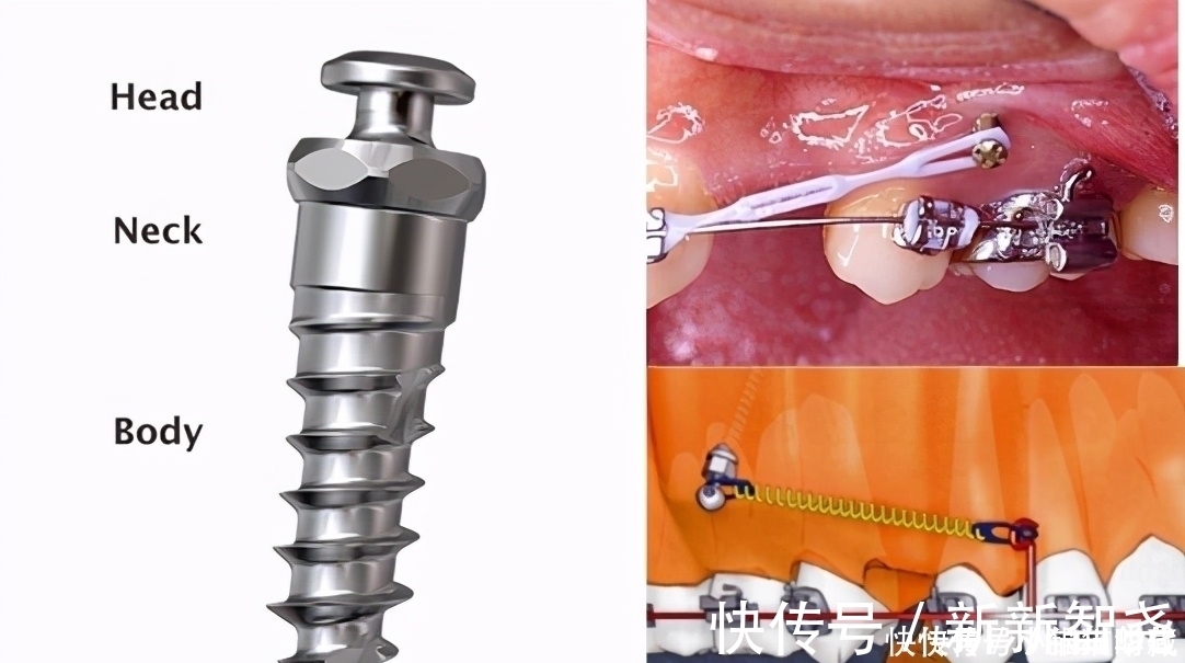 牙槽骨|牙齿矫正一般是什么时候打骨钉？矫正是不是必须打骨钉？