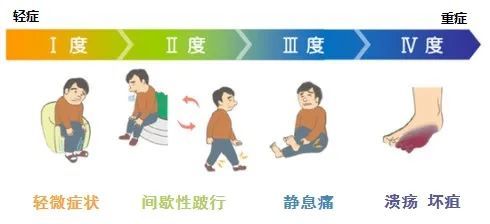 血管外科|艾灸后,绍兴大爷差点截肢 专家:5个老年人里就有一个中招