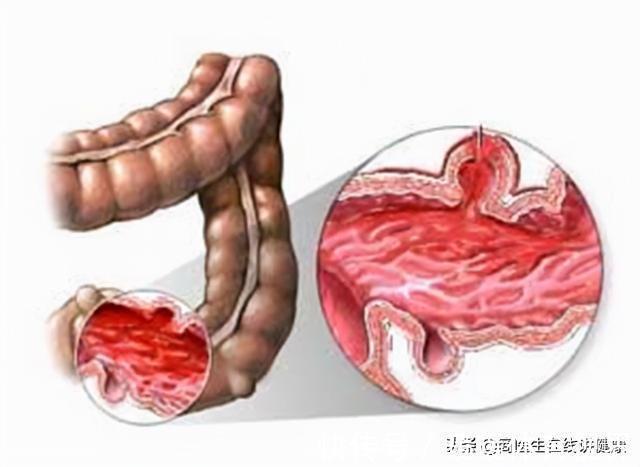 大爷|有高血压的人要注意了，医生：出现这3种状况当心脑出血，要警惕