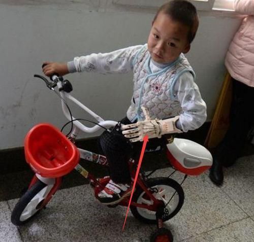 截肢|在医院做完截肢手术以后,医院会怎么处理“断肢”呢说了你可能不信