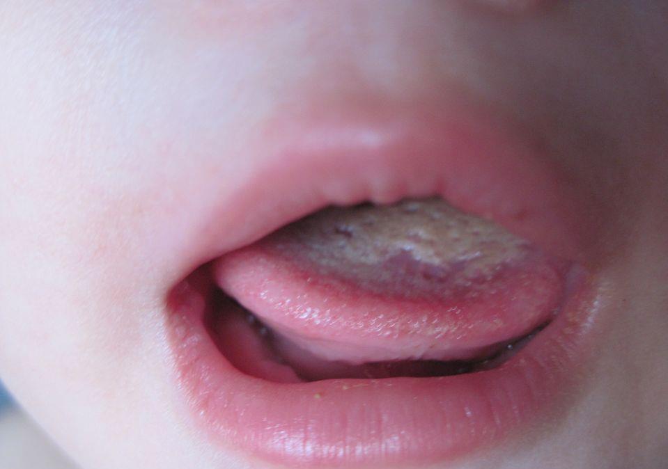 山药|2岁女童查出“肠坏死”,医生:除了果汁,2种“营养”也少吃