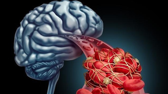 中国|世界一半的脑梗患者都在中国,医生告诫量少两不要,才不堵塞血管