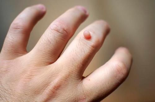 睡眠时间|脖子和腋下的“小肉粒”是什么?可以用手拉吗?