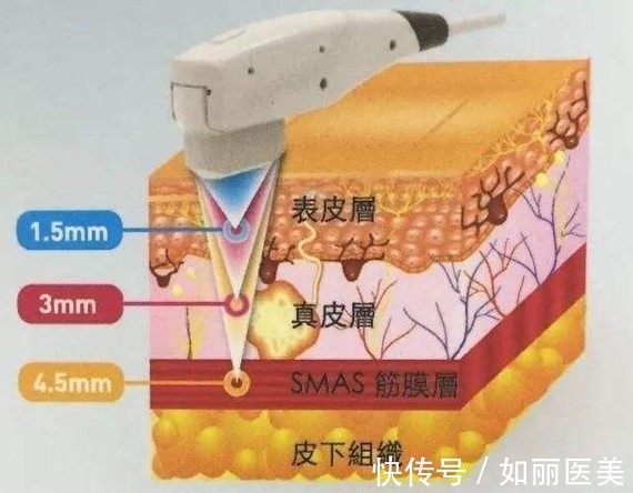 超声提升 热玛吉&超声提升,谁是抗衰NO.1?抗衰选它就对了!