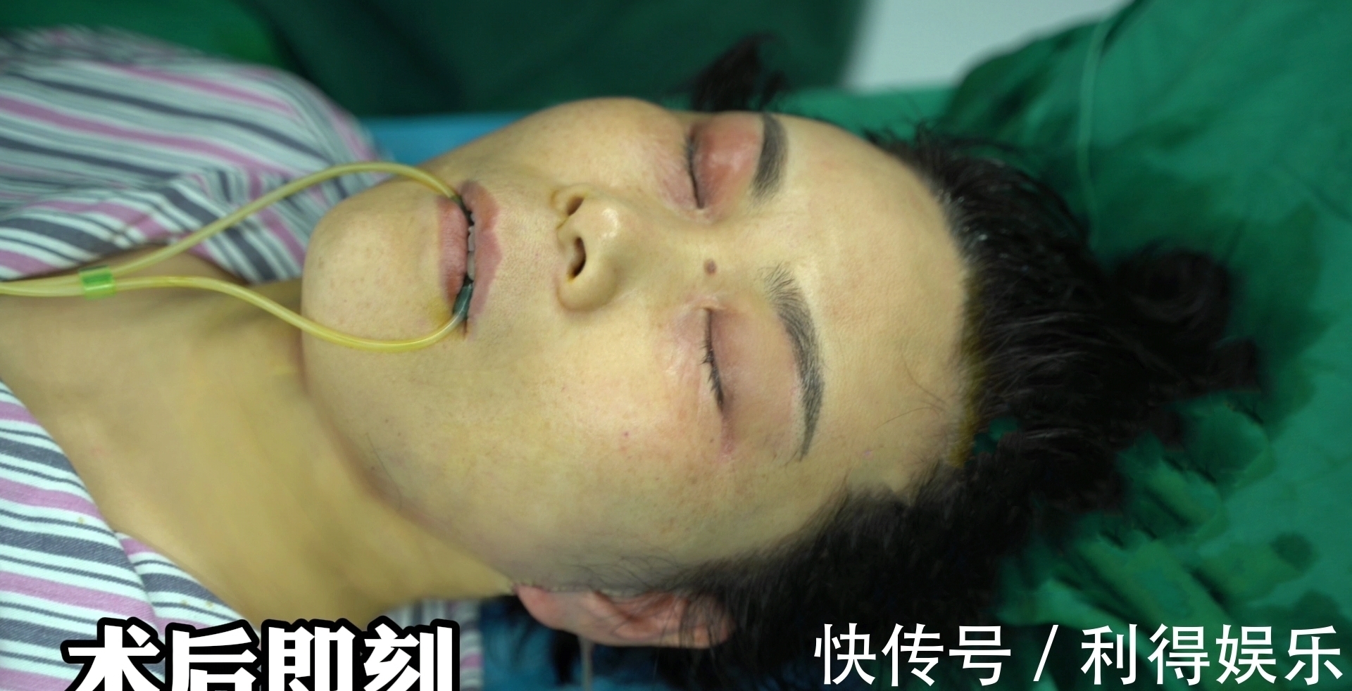 拉皮 48岁女士拉皮手术真实记录,拆线即刻很“惊艳”!