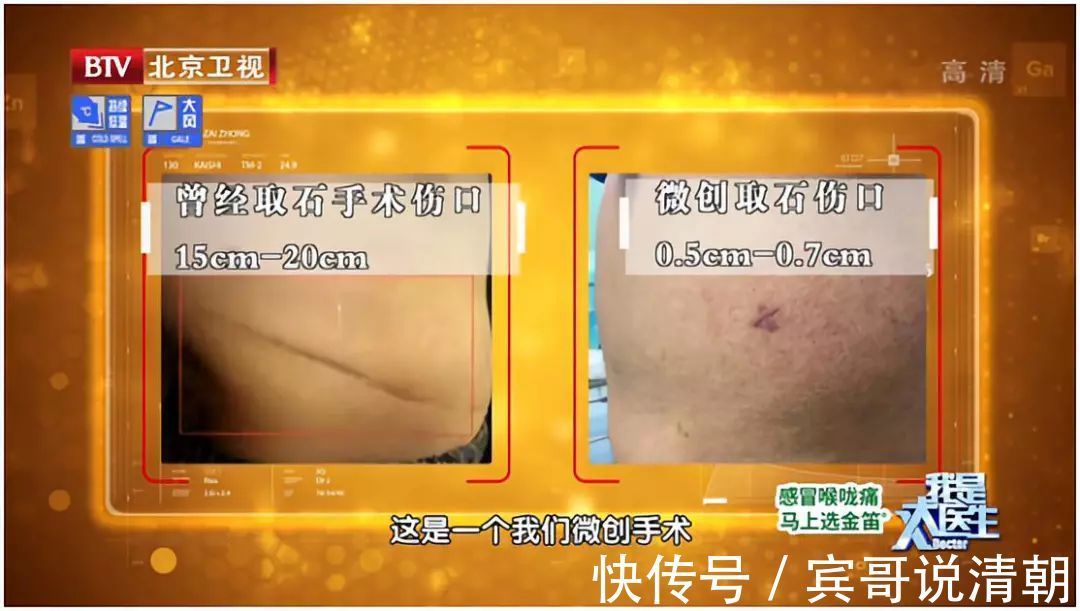 结石|致命肾癌竟是结石惹的祸2大饮食习惯暗藏风险，可惜很多人不知