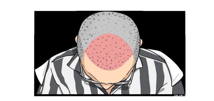 移植|揭秘植发全过程:一次植发能维持多久?哪些人不适合做?有多贵?