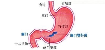 幽门螺杆菌感染|幽门螺杆菌感染，到底该咋办？（健康直通车（第80站））