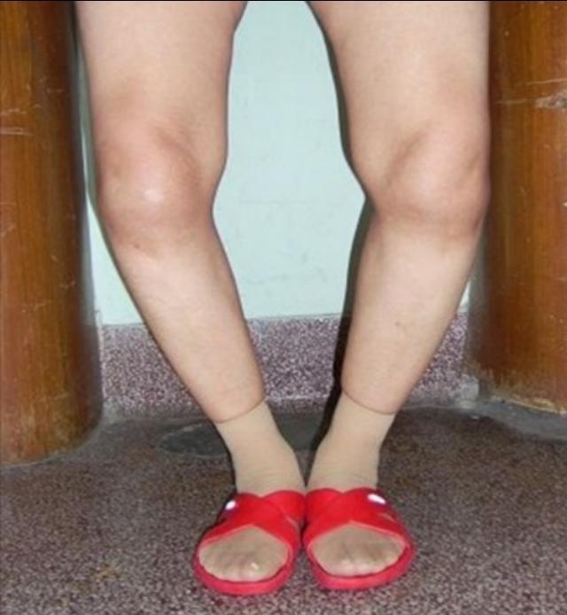 膝关节|膝关节很奇怪,上下楼梯,蹲起蹲起就疼,走平路不疼,咋回事