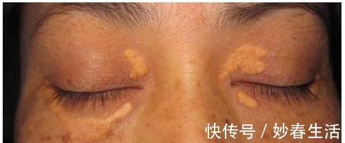 淡黄色|眼睛出现3情况,血脂已经挤满血管,常用2方法,清掉多余血脂