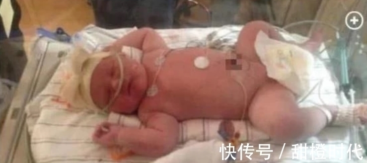 巨婴|出生时曾轰动美国的14斤“巨婴”，30多年过去了，今怎么样了？