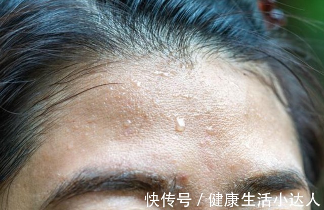 调养|出汗是身体在排毒?未必!三个地方出汗多,或是健康出了问题