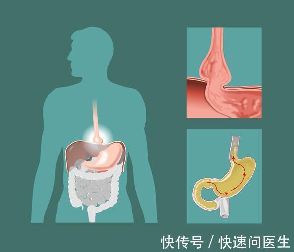 并发症|肝硬化患者,身体多个脏器可能“陪同”发病,并发症风险增加