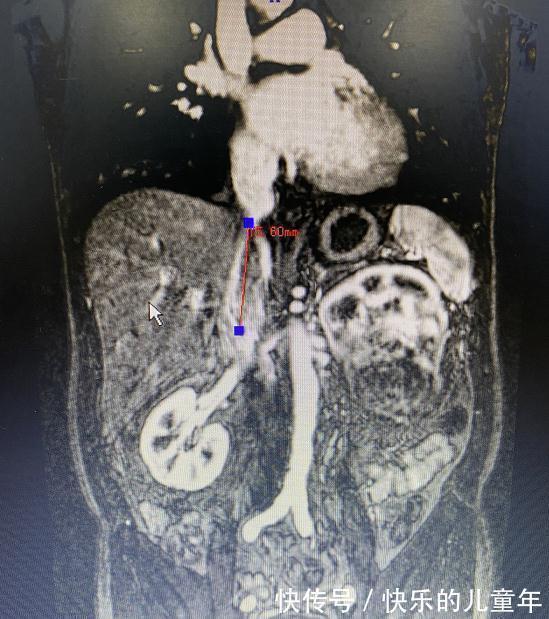 湖南省人民医院|腰痛一年多,男子肾脏长“鹅蛋”肿瘤!专家勇闯“雷区”成功摘除