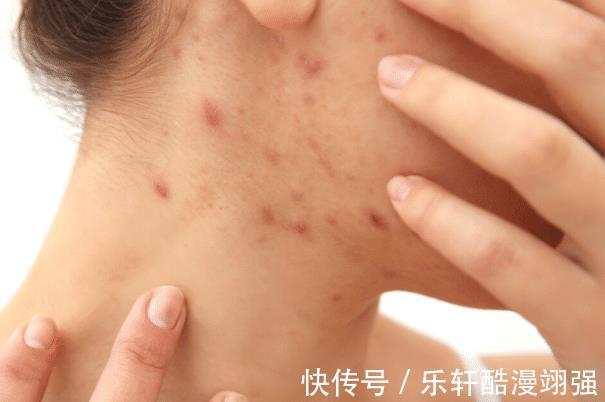 失眠|肝火旺的“克星”来了,枸杞搭配“1物”,清肝火,告别失眠!