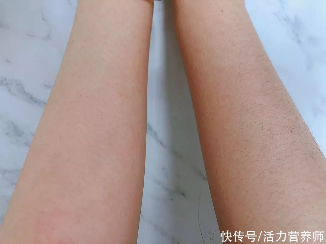 身体不适|为什么有些人汗毛是白的,还有些人是黑的?哪种视为正常现象?